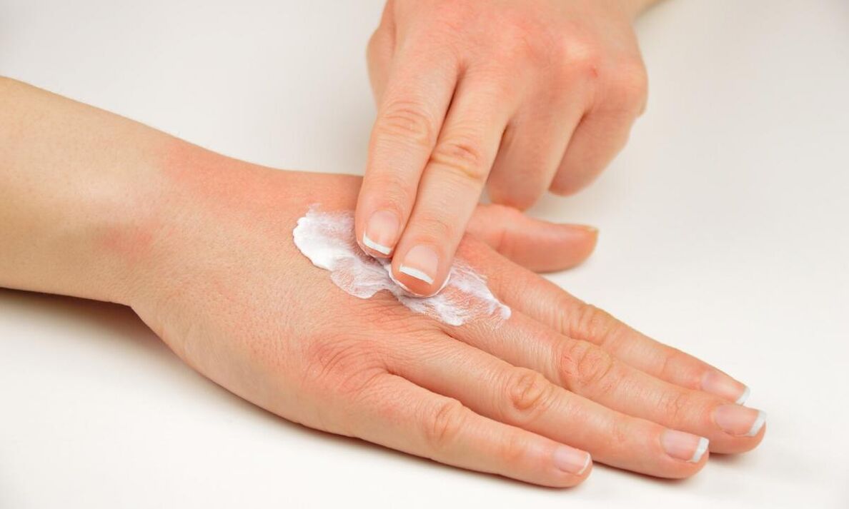 Tratar la psoriasis con crema Keramin