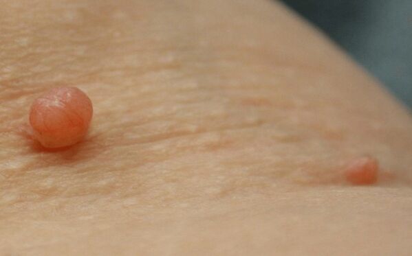 Papiloma en el cuerpo.