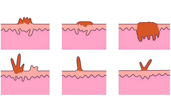 Tipos de papilomas en el cuerpo.