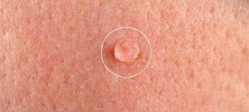 Verrugas genitales en el cuerpo.