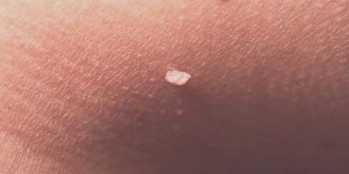 Virus del papiloma humano en la piel