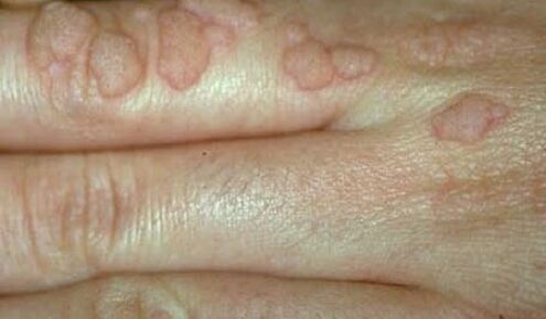 Virus del papiloma humano en las manos